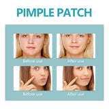 Hydrocolloid Acne Patch Repair Acne Cleansing Invisible Breathable Waterproof Acne Cleansing Concealer Fade Clean
